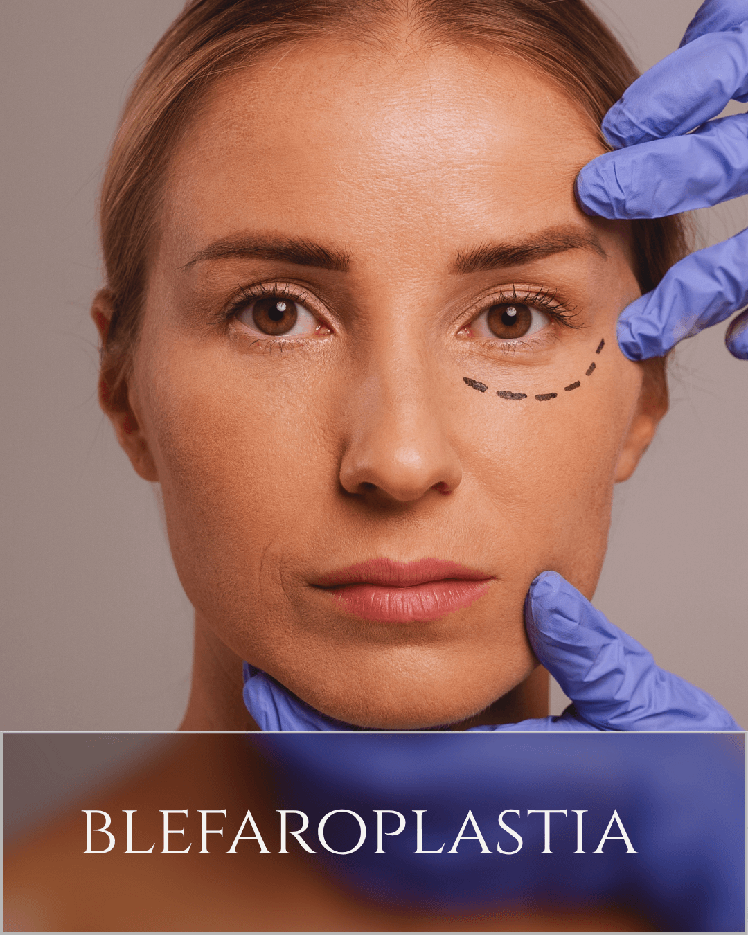 blefaroplastia (1)