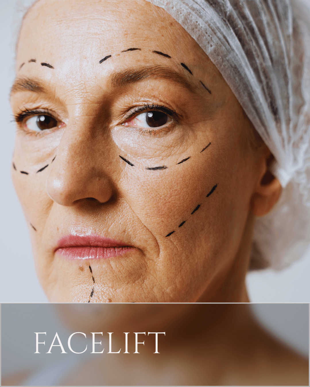 facelift (2) (1)