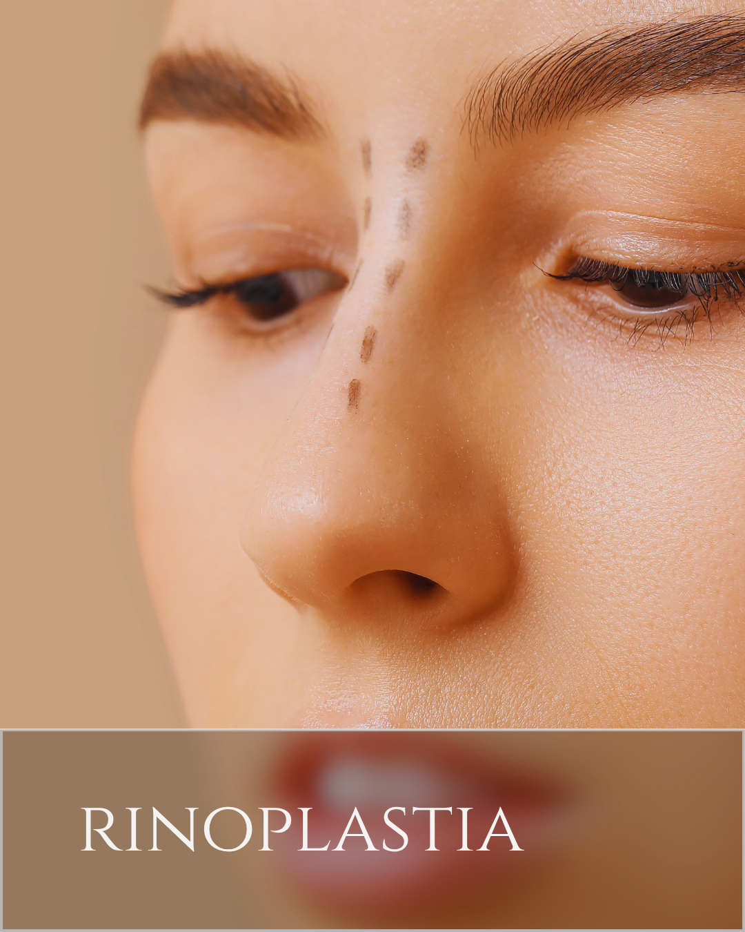 rinoplastia