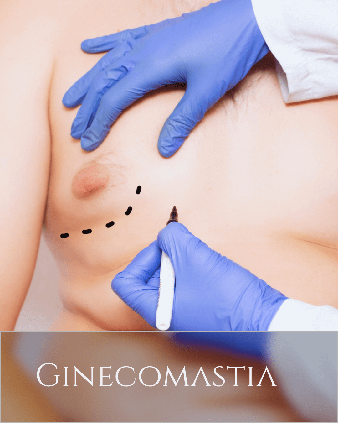ginecomastia (1)
