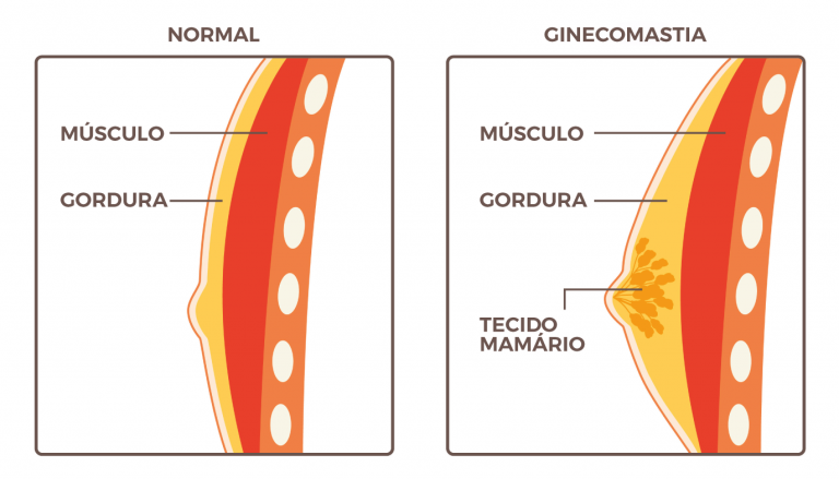 exemplo-ginecomastia