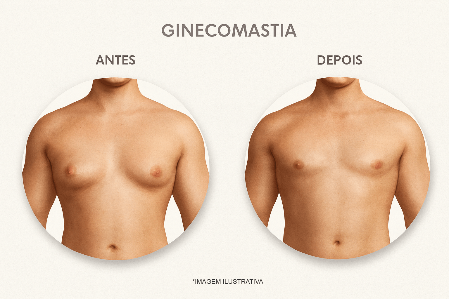 resultado-ginecomastia